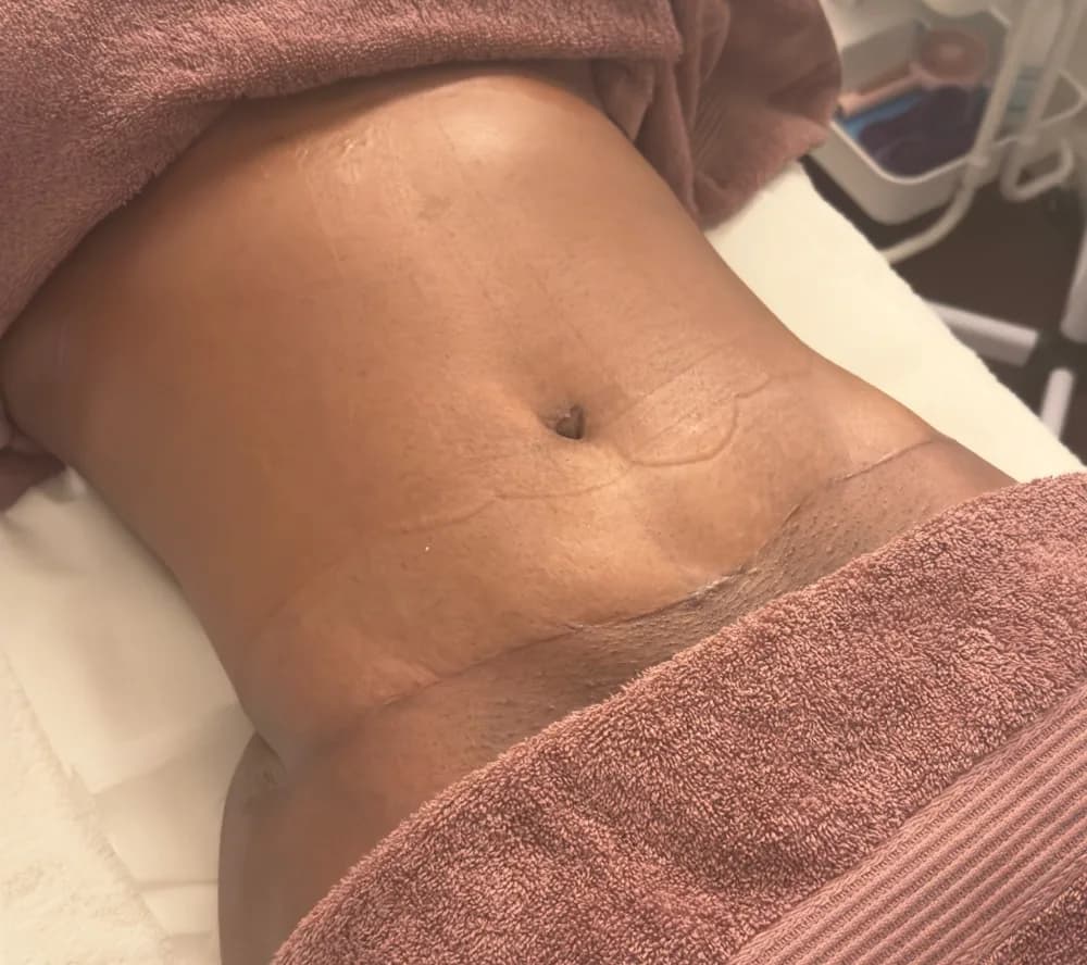 Before the recovery programme, abdomen