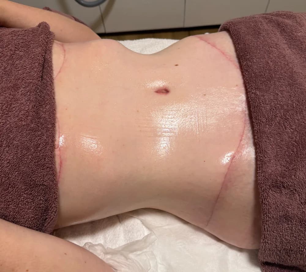 After the recovery programme, abdomen