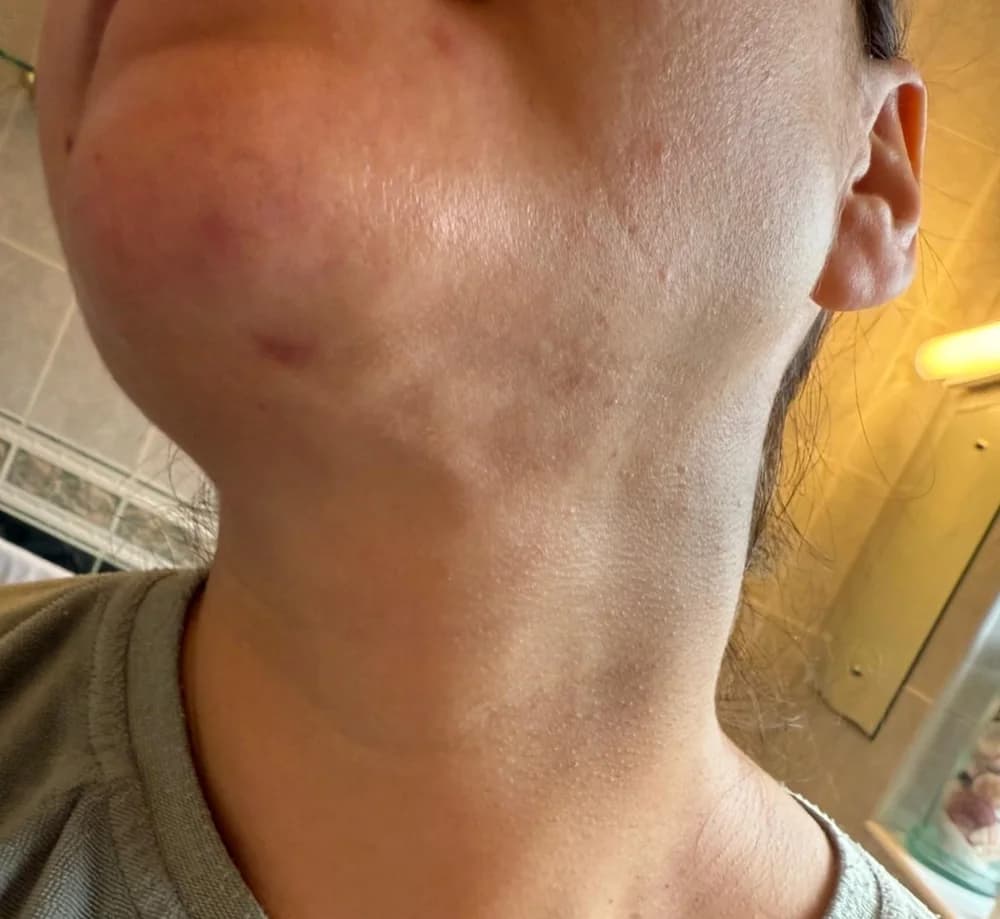 After the recovery programme, jawline and neck