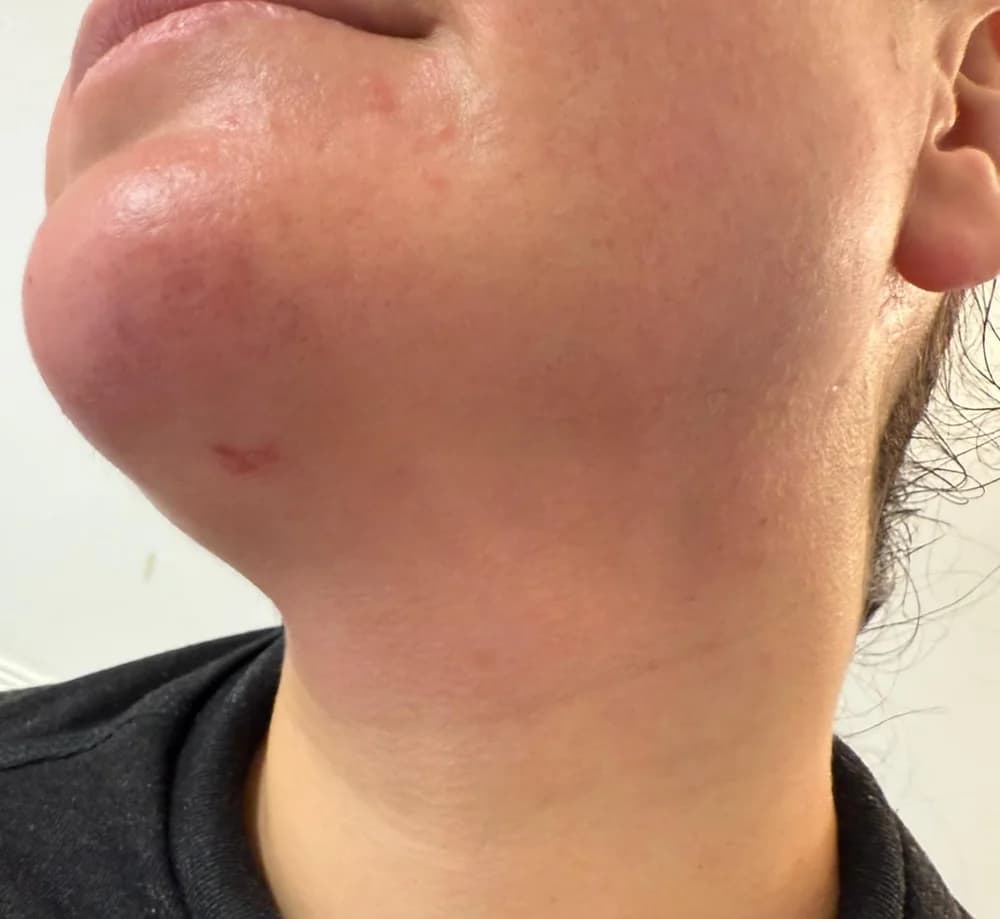 Before the recovery programme, jawline and neck