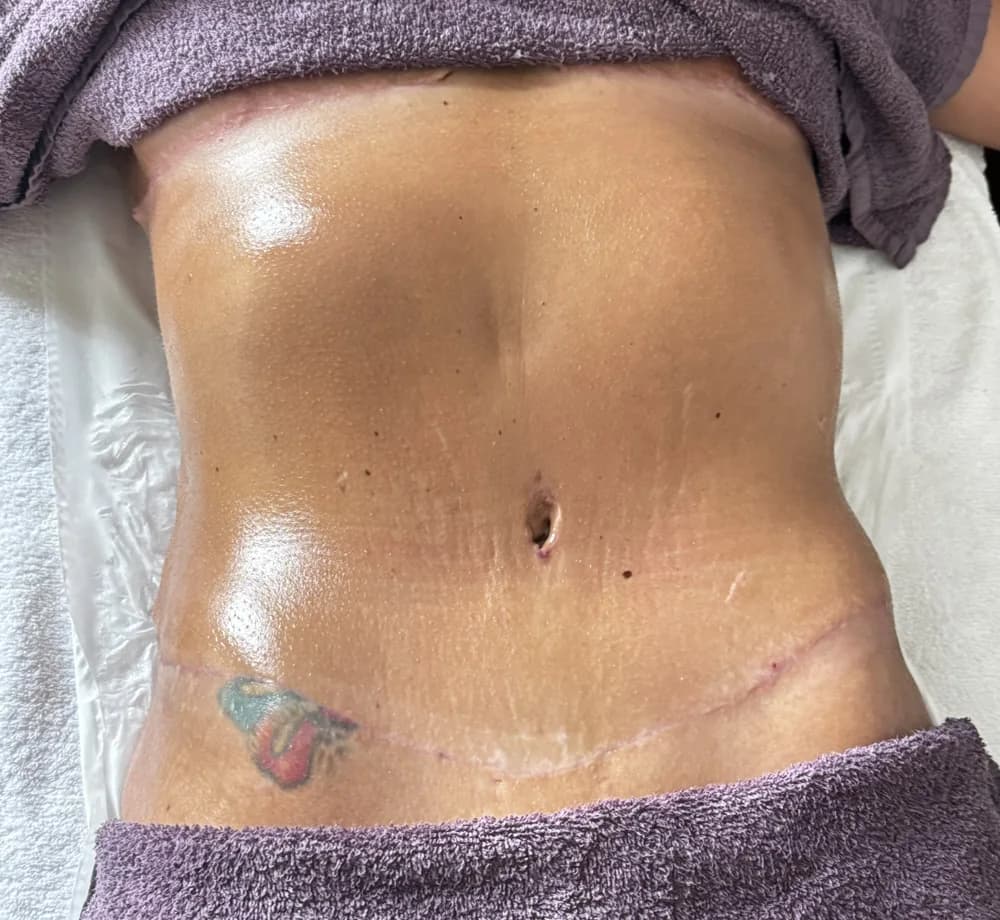 After the recovery programme, abdomen
