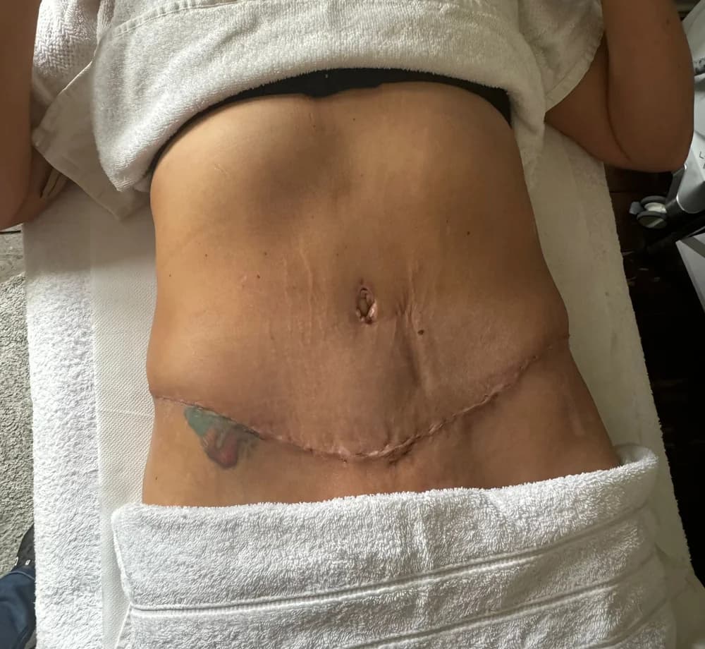 Before the recovery programme, abdomen